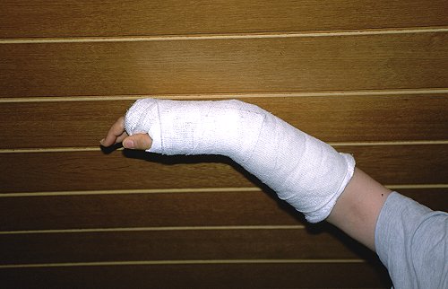 Zuhause gab's einen geknickten Gips.